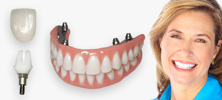 dental-lab-product-dental-implants